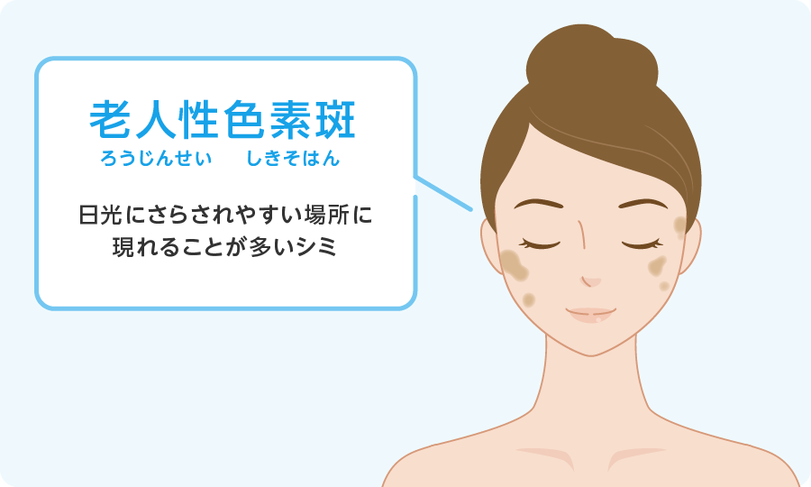 老人性色素斑