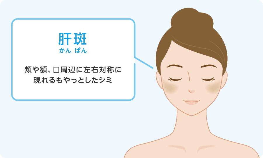 肝斑
