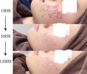 水光注射 非架橋型ヒアルロン酸