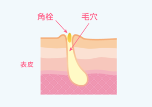 毛穴が角栓で詰まっている様子